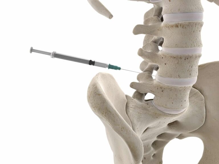 椎間盤 3d rendered medically accurate illustration of a lumbar spine injection