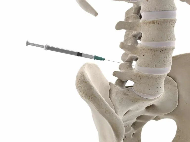 椎間盤 3d rendered medically accurate illustration of a lumbar spine injection