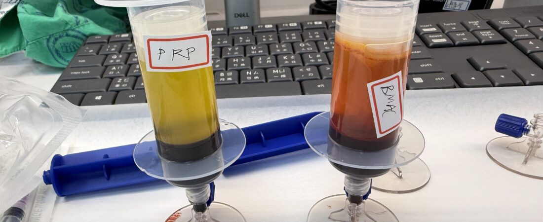 血小板品質影響 PRP 療效：MPV 與 IPF 在膝關節炎治療中的關鍵角色