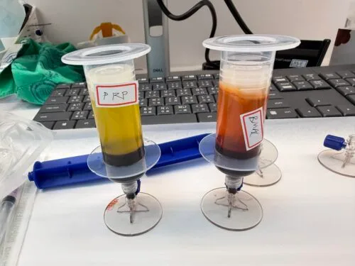 PRP 治療