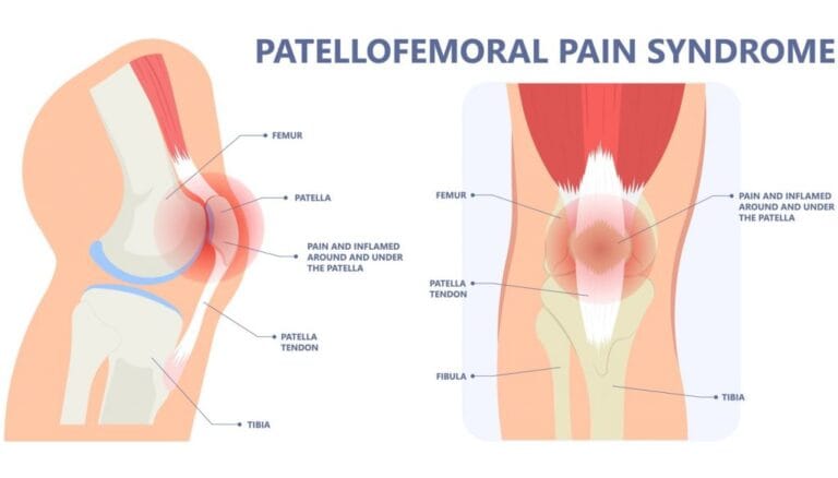patellofemoral