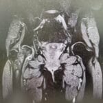 雙側髖關節冠狀面核磁共振（MRI）影像，用於評估股骨頭缺血性壞死