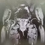 雙側髖關節冠狀面核磁共振(MRI)影像,用於評估股骨頭缺血性壞死