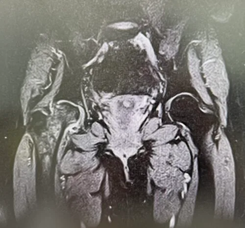 雙側髖關節冠狀面核磁共振（MRI）影像，用於評估股骨頭缺血性壞死