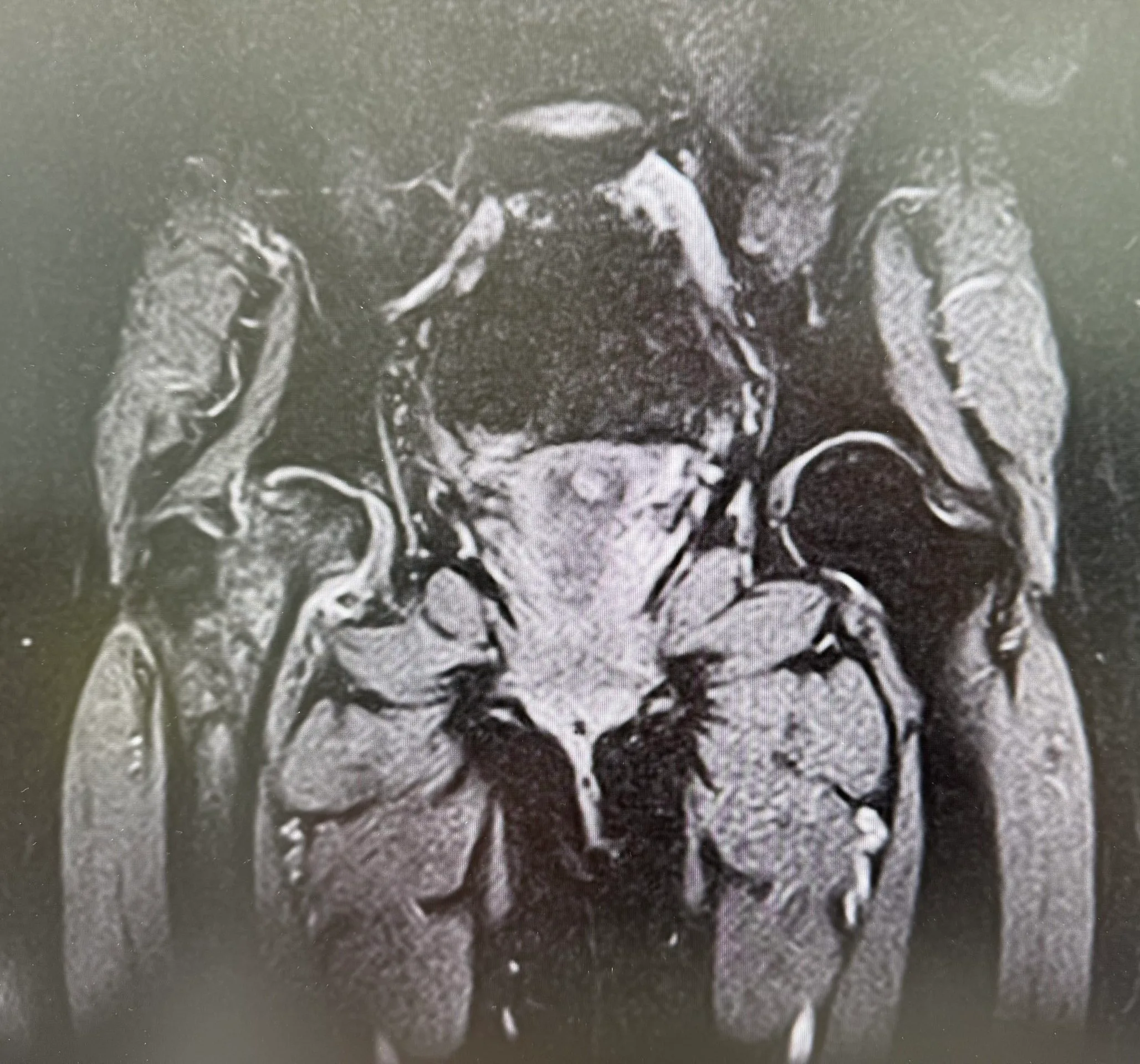 雙側髖關節冠狀面核磁共振（MRI）影像，用於評估股骨頭缺血性壞死