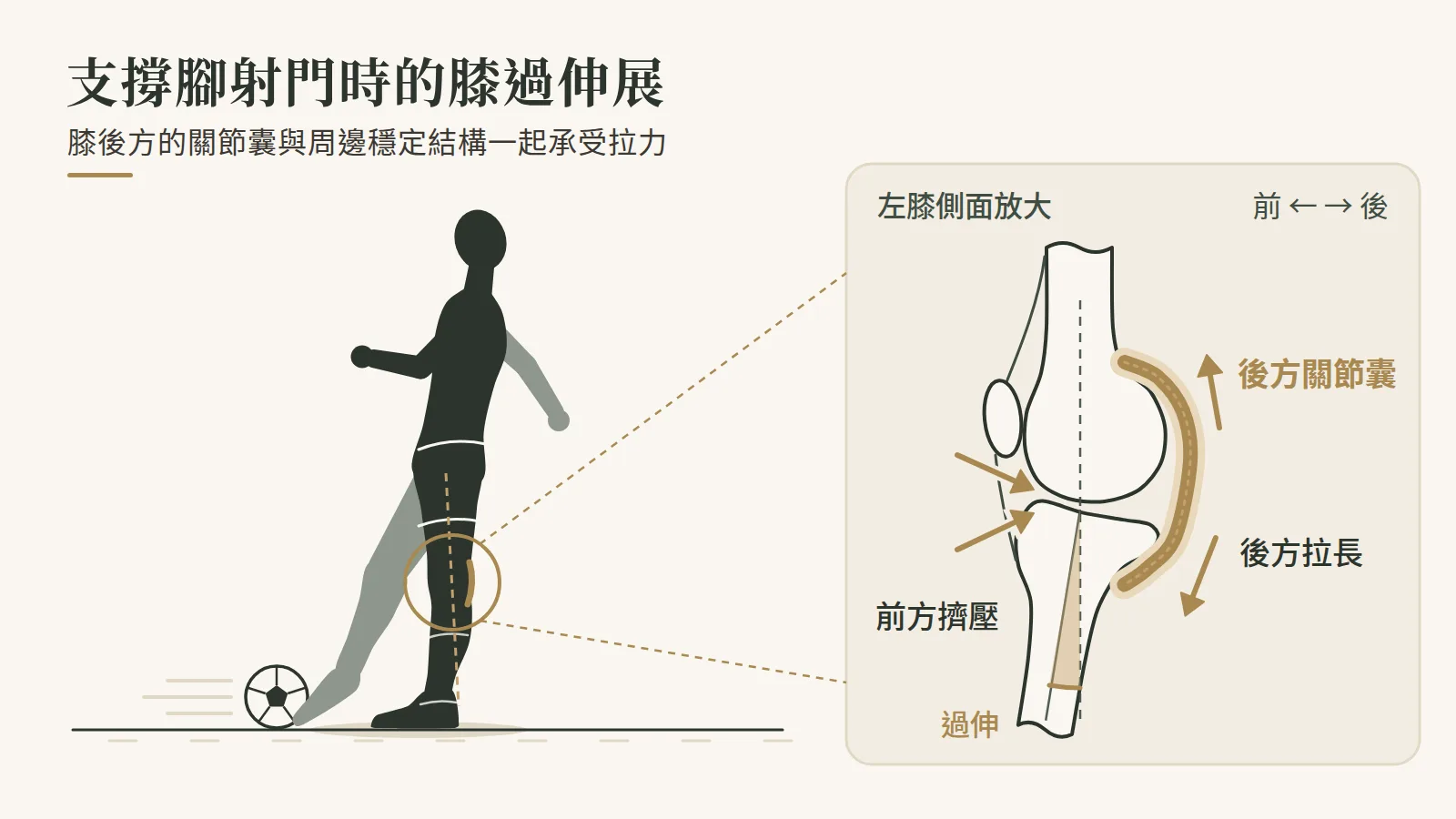 膝蓋過伸展示意圖,支撐腳射門造成膝後方關節囊受力