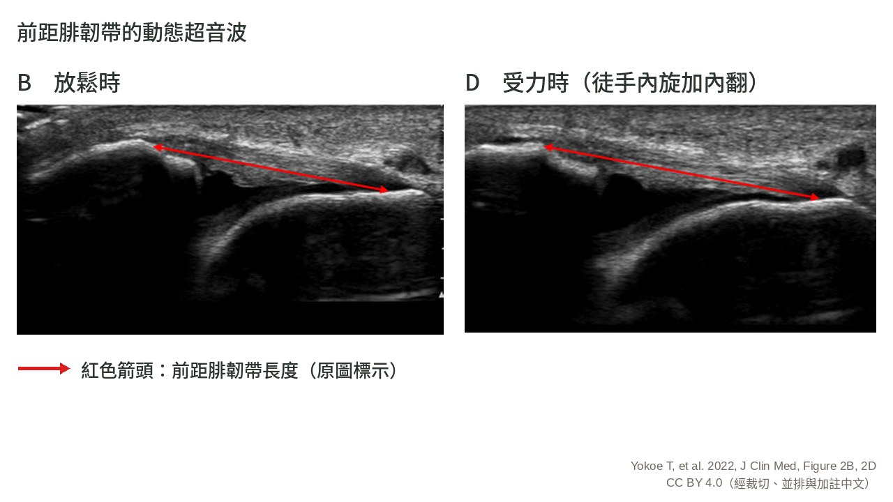 前距腓韌帶在放鬆與受力時的超音波對照影像
